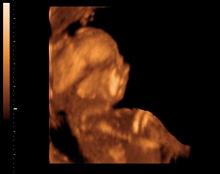 Рисунок 1: 3D/4D эхограмма. Беременность 17 недель. Гипоплазия нижней челюсти у плода. Ложный прогнатизм.