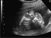 Рисунок 4: 2D эхограмма. Беременность 21 неделя. Боковая расщелина лица. Односторонняя анофтальмия.