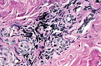 Рисунок 2: Фрагмент мягких тканей с умеренной субэпителиальной воспалительной инфильтрацией. Окраска гематоксилином и эозином. Увел. ×400.