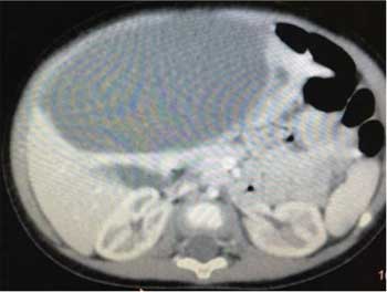 КТ-изображение в аксиальной плоскости уровня печени и почек ребенка после внутривенного контрастирования